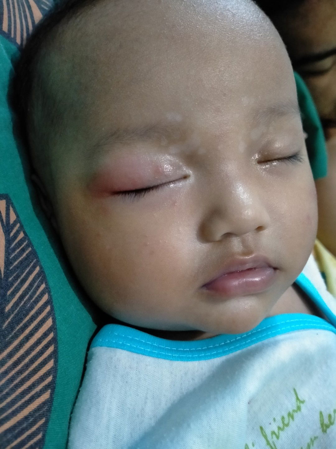 Kelopak Mata Bengkak dan Memerah