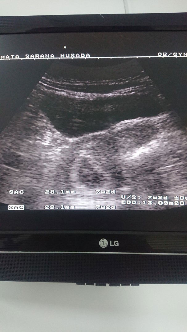 Mommies dan para bunda, share pengalaman dong. kalian selama hamil trimester pertama ada yang pernah flek ga? seberapa sering