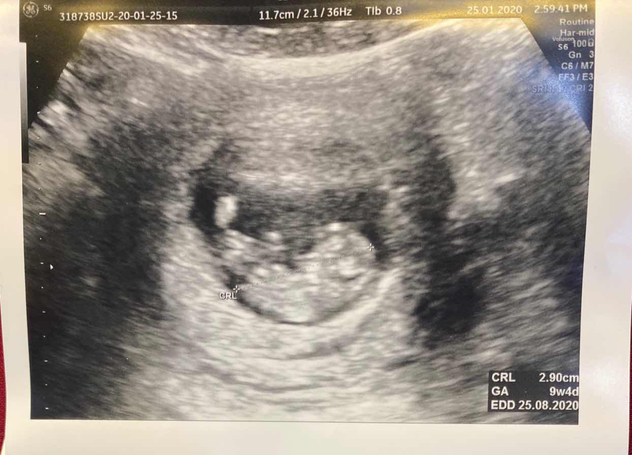 คนท้อง....งอแงทุกคนไหมคะ?