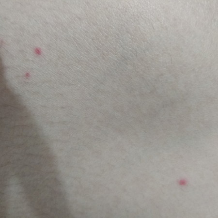 Bintik merah di tangan dan paha