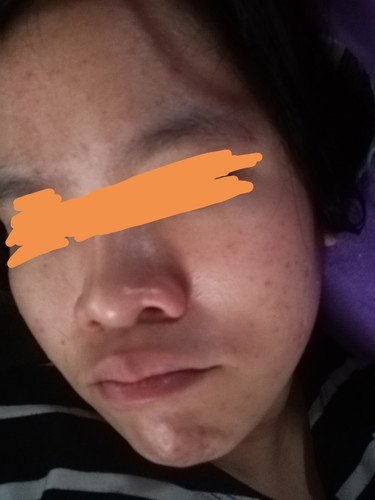 RASHES/PIMPLES