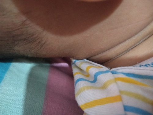 alergi atau biang keringat