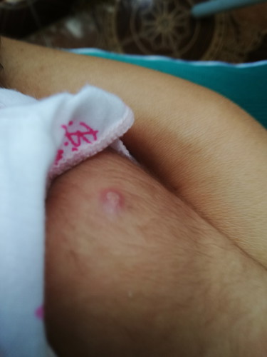 รอยปลูกฝีของลูก