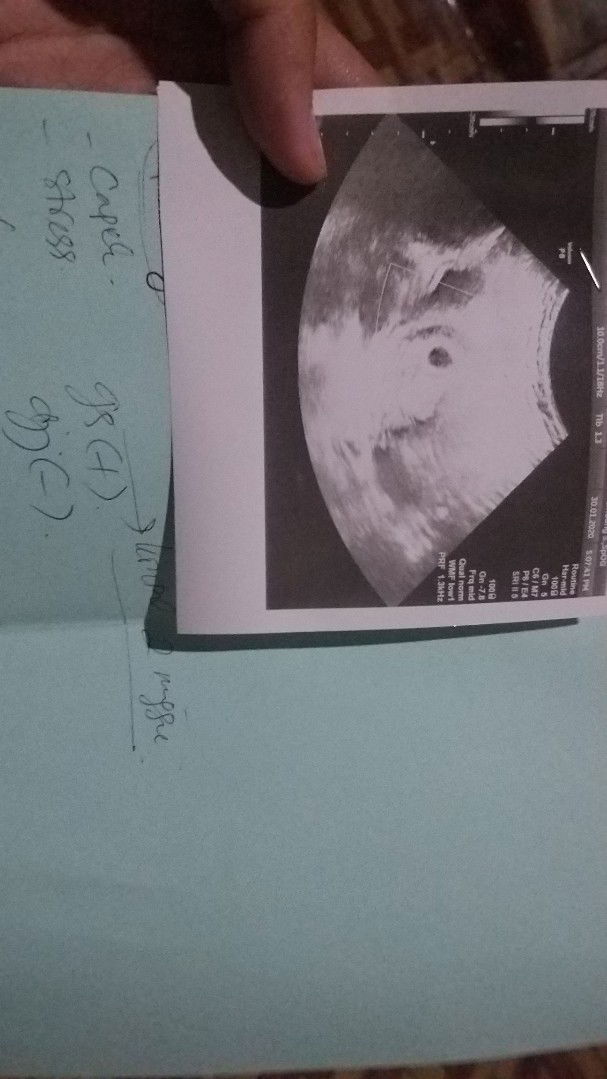 haid terahir 25 nov tapi janin belum ada detak nya?