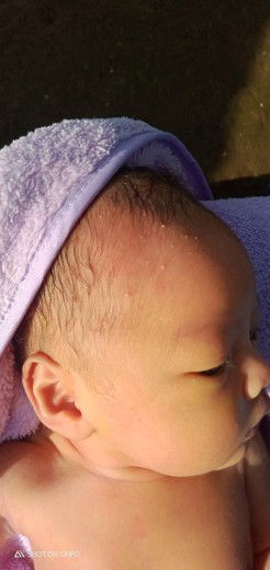 beruntusan bernanah.