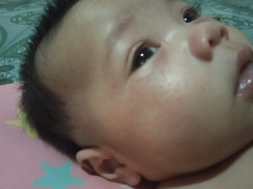 อาการแพ้