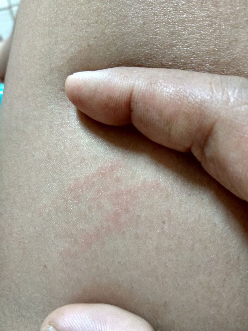 bintik merah berisi cairan