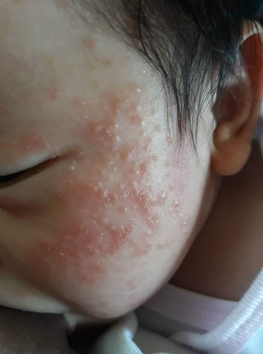 Rashes ni Baby