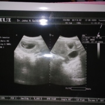 kehamilan pertama disertai kista