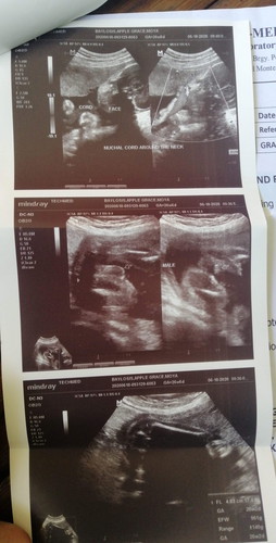 Nuchal Cord Around The Neck