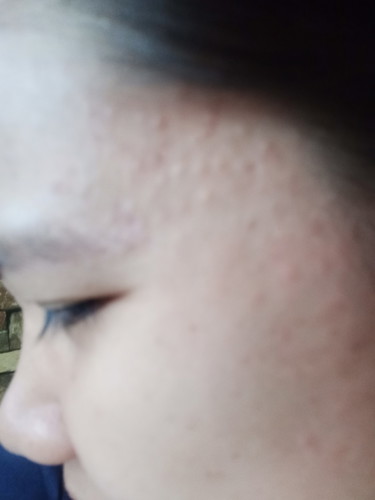 butlig sa mukha