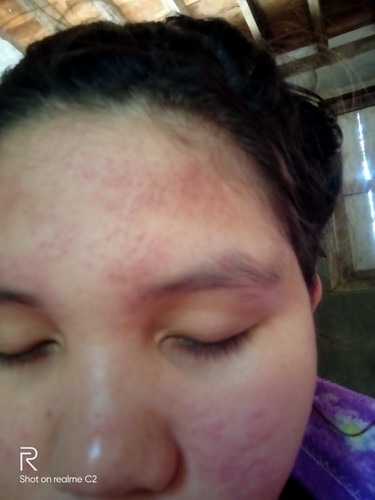 ผื่นหลังคลอด