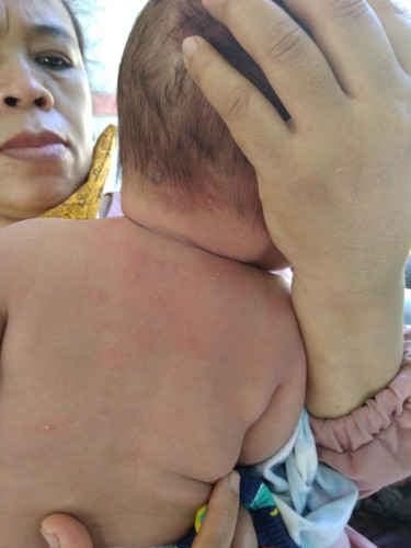 tumbuh merah dikulit bayi