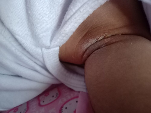 rashes po ba to????