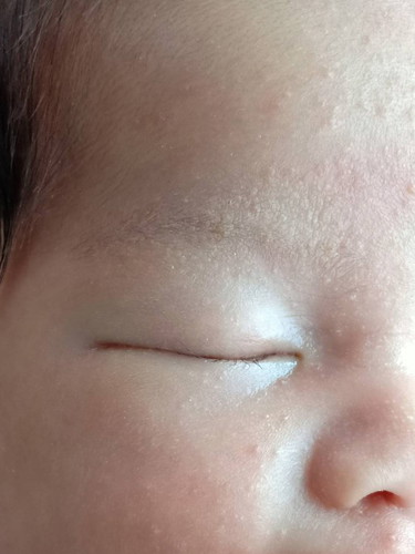 ลูกหน้าและคิ้วเป็นผื่น