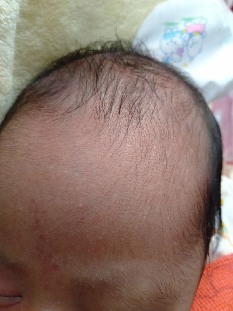 ผื่นใสหรือตุ้มใสเปนเหมือนตุ้มน้ำ