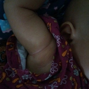 benjolan di ketiak bayi