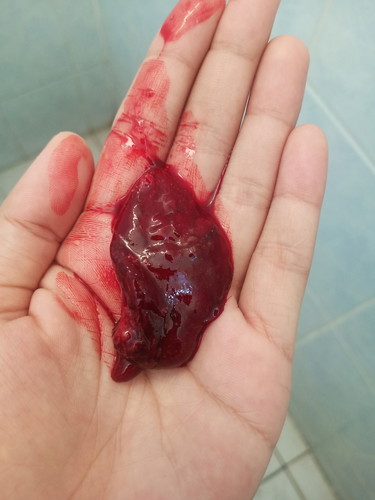 ขูดมดลูกโพสเมื่อ 24/03/2563. 14.00น