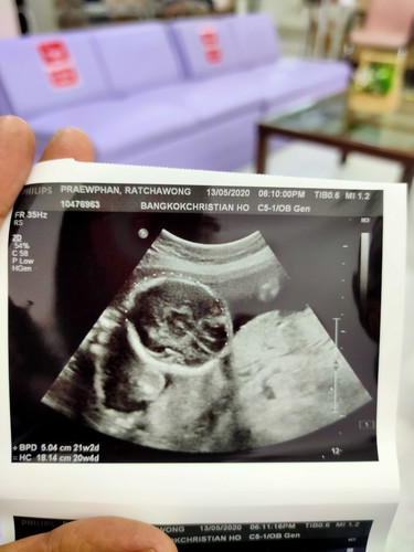 อยากทราบขนาดศรีษะน้องในแต่ละวีคว่าต้องขนาดเท่าไรครับ