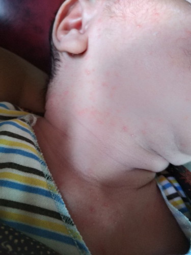 Bintik merah pada bayi