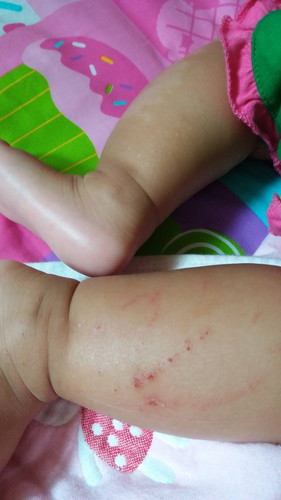 ลูกเป็นแผลแบบนี้ไม่รู้ว่าเกิดจากอะไรคะ