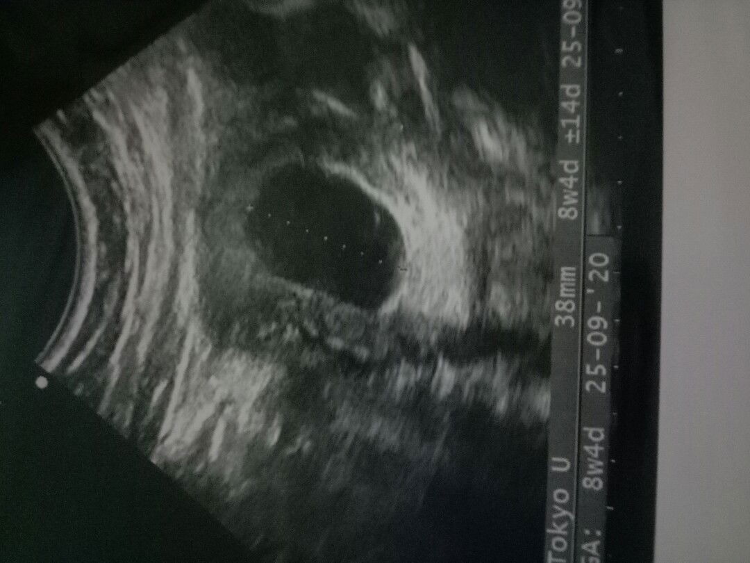 Kehamilan Kosong ???  9 minggu