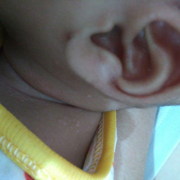 leher bayi seperti ruam