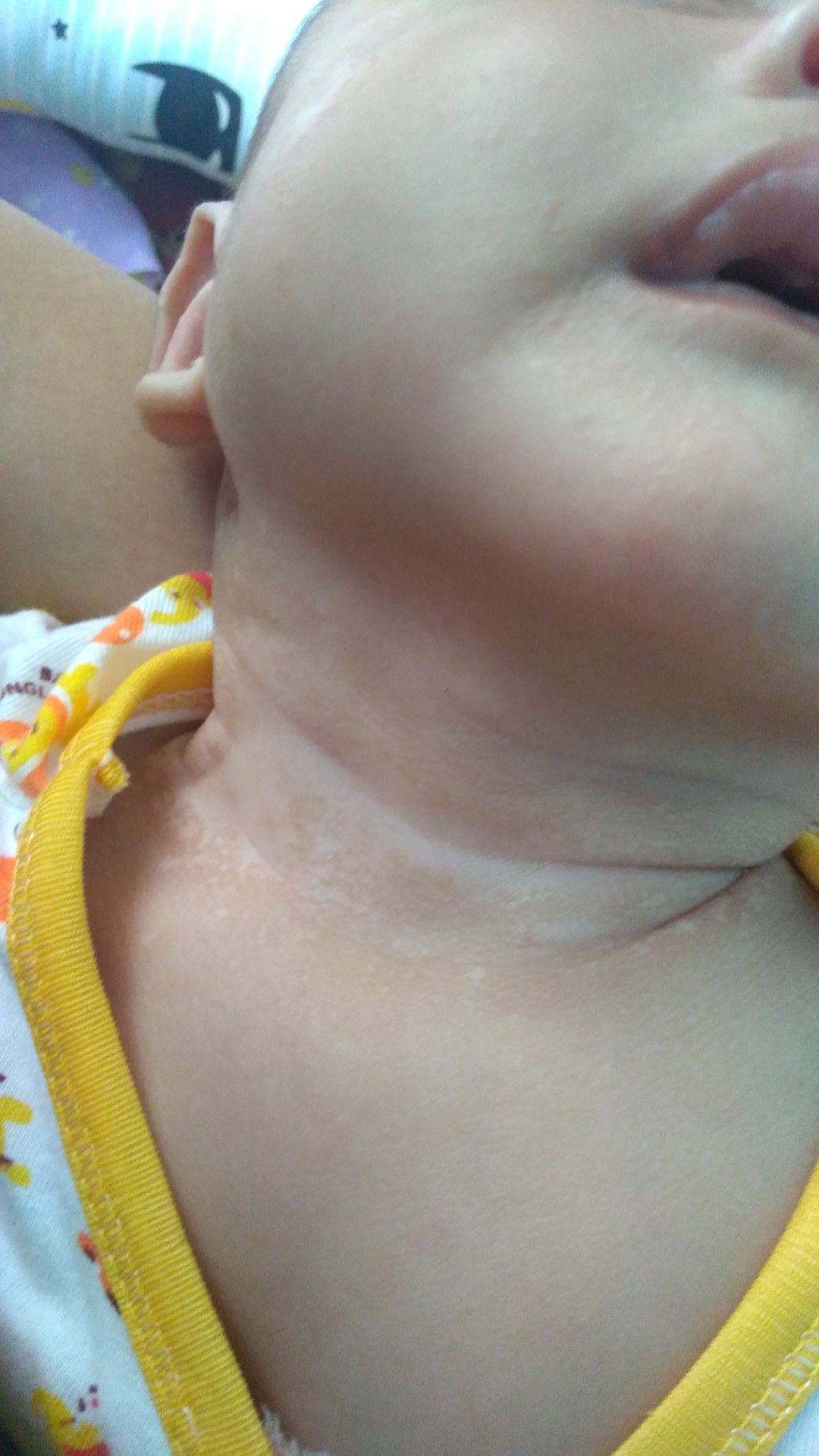 bercak putih di leher