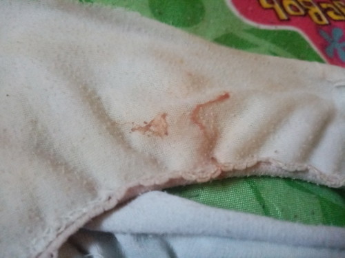 Red Discharge 24 Weeks & 4days