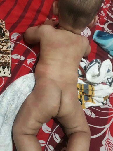 kulit kemerahan pada bayi