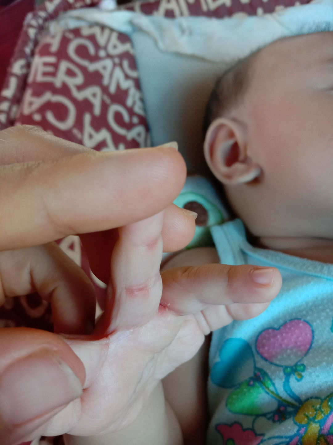 ตุ่มแดงที่มือ