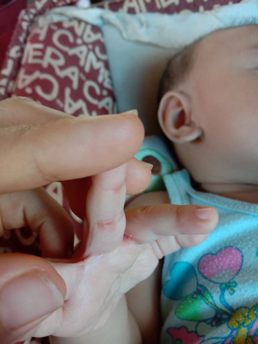 ตุ่มแดงที่มือ