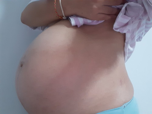 ท้องแตกลาย