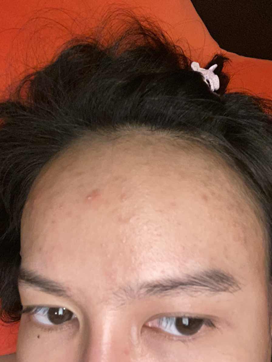 คุณแม่ท่านไหนกำลังเจอปัญหาสิวแบบเราบ้างคะ ?