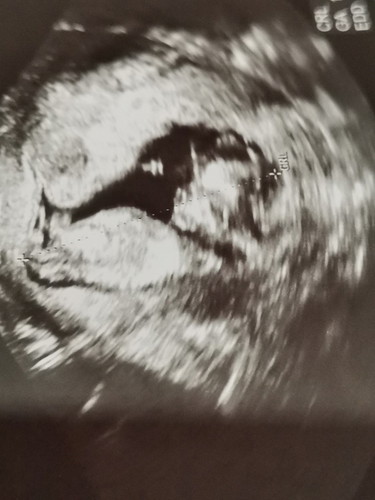 Baby Gender