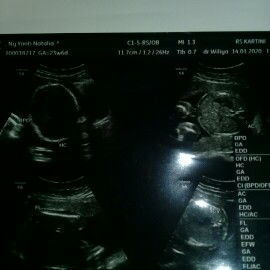 ini hasil usg kemaren