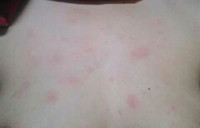 itchy