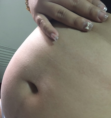 16 weeks. ผื่นคันขึ้นหน้าท้อง