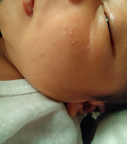 Baby Acne