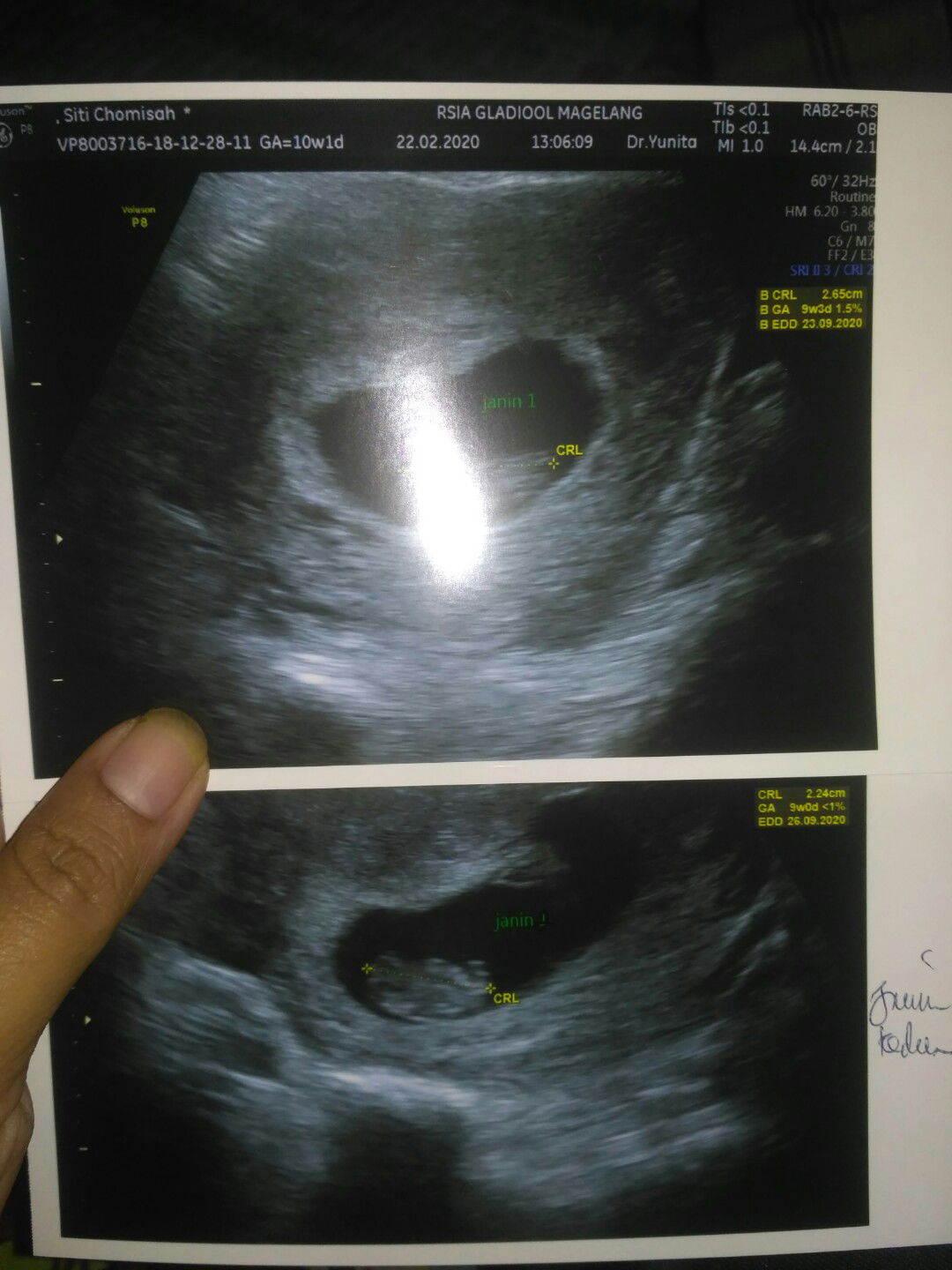 hamil kembar 2 kantong dan 2 plasenta