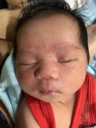 น้องเป็นผื่นแบบนี้อันตรายไหมค่ะ มีขึ้นตามตัว หน้า หัว แขน ขา
