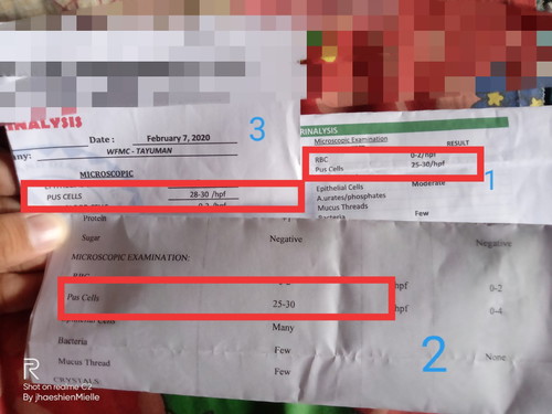 Di gumagaling na UTI