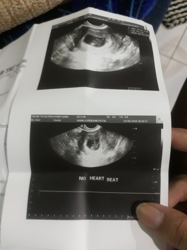 no heartbeat 8 weeks
