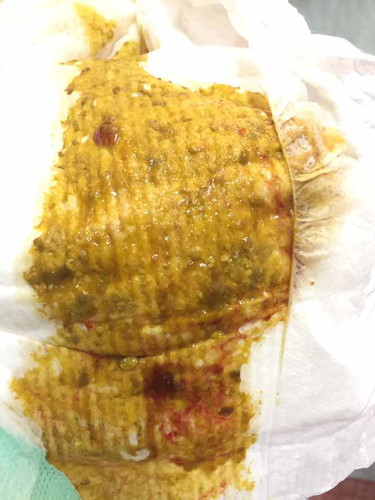 อึลูกมีเลือดปน