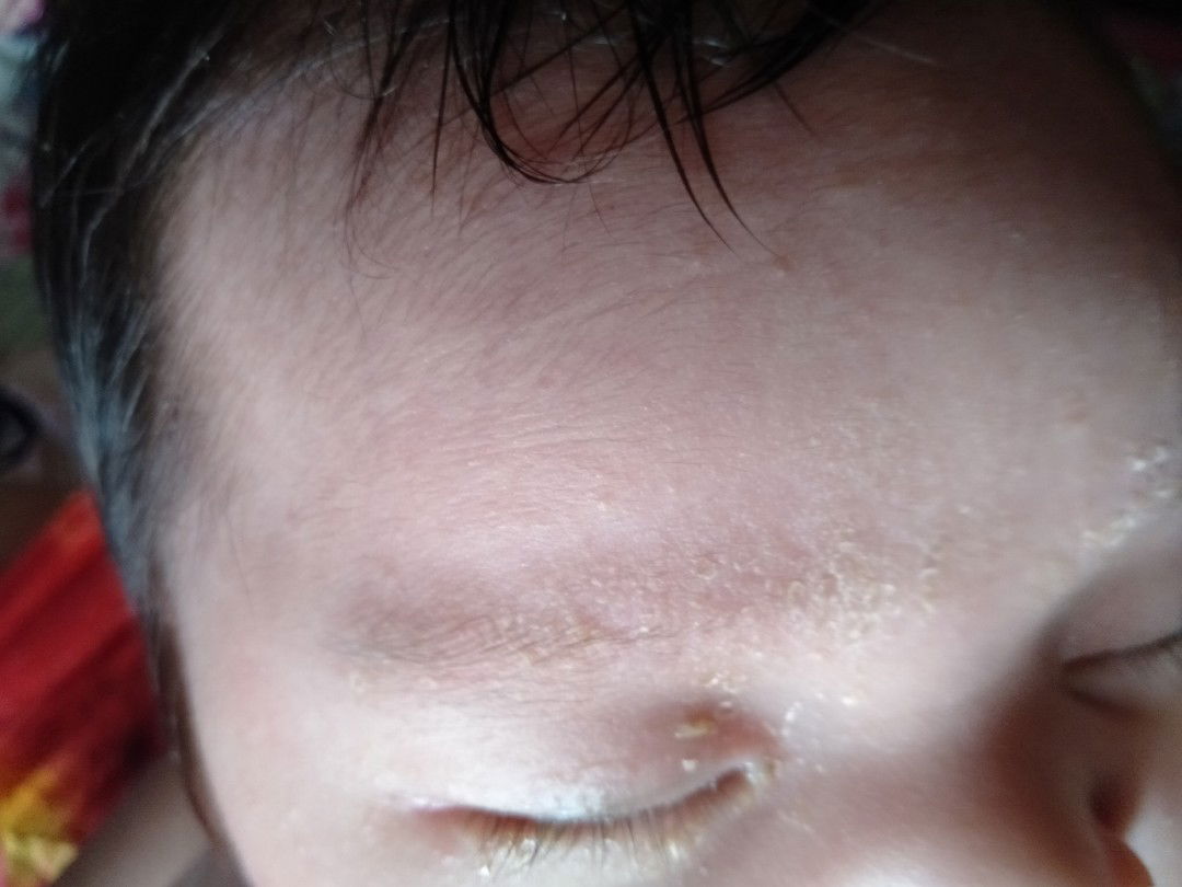 Bungang araw ba ito? or naging ganito dahil sensitive sa sabon?