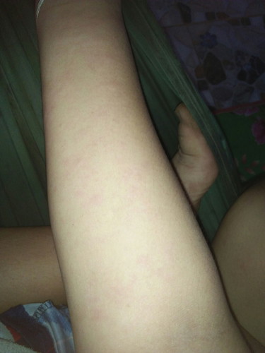 เวลาโดนน้ำแล้วมือเท้าจะเป็นแบบนี้ค้ะ