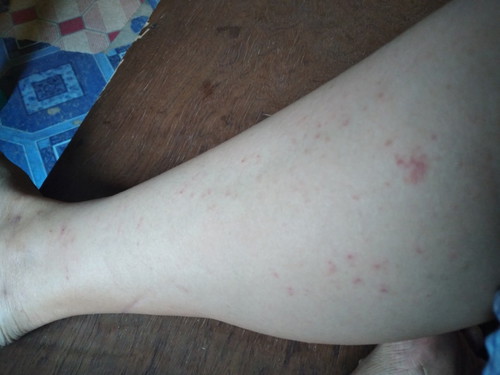 IRRITATING ITCHY RASHES