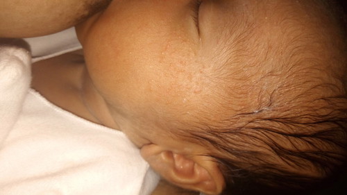 bintik merah di pipi