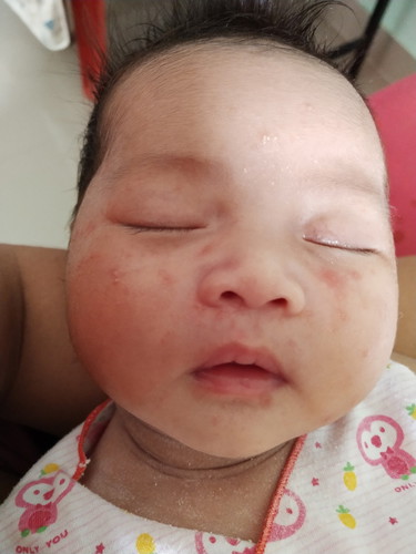 ผื่นขึ้น