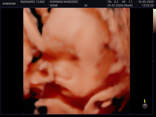 มีแม่ๆท่านไหนรกเกาะต่ำบ้างค่ะ